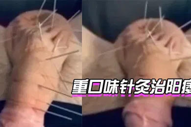 【自拍偷拍】针灸治阳痿你想试下吗